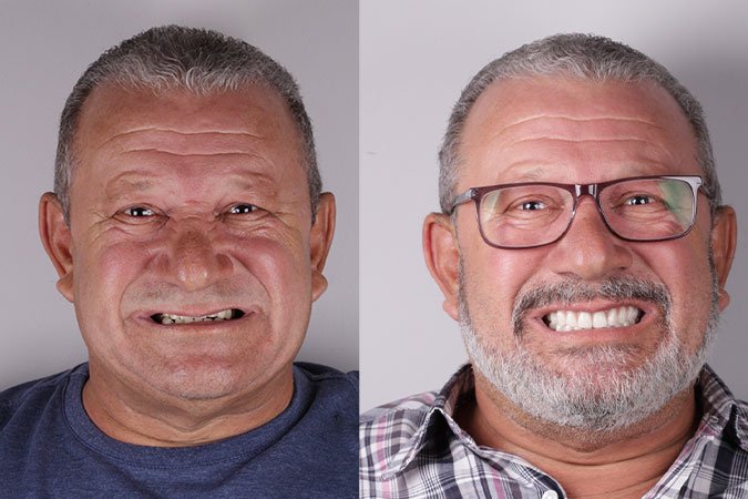 Caso 1 - Transformação de sorriso
