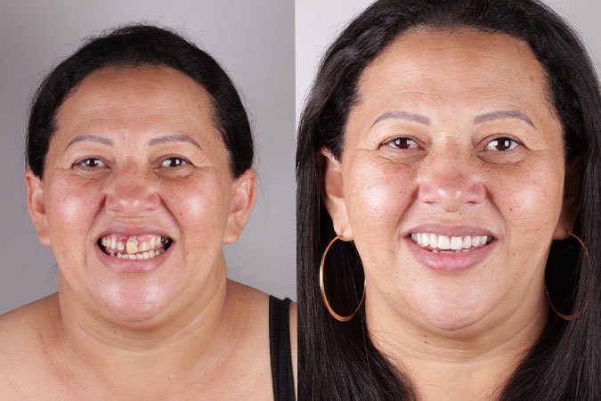 Caso 2 - Implante dentário