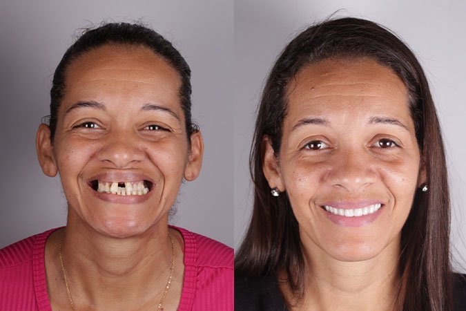 Caso 4 - Sorriso novo